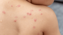 Image of Monkeypox or shingles?: the keys to differentiating symptoms